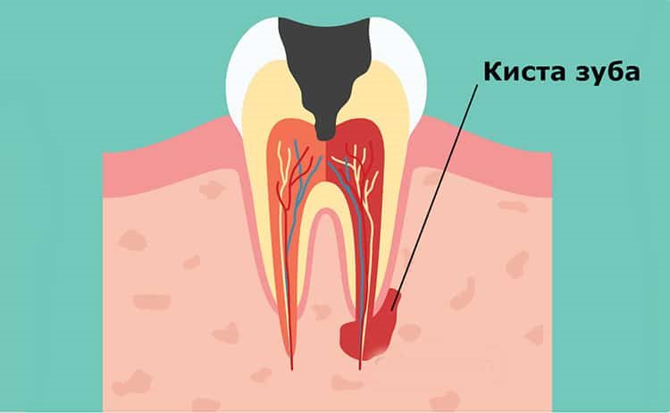 кистозное образование зуба
