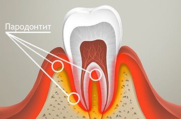 воспалительный процесс в десне