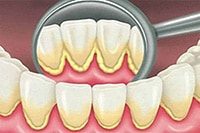 твердые отложения на зубах