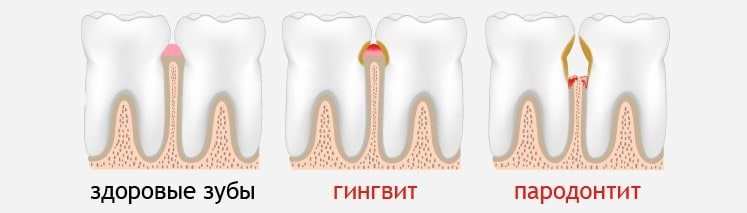 гингивит и пародонтит