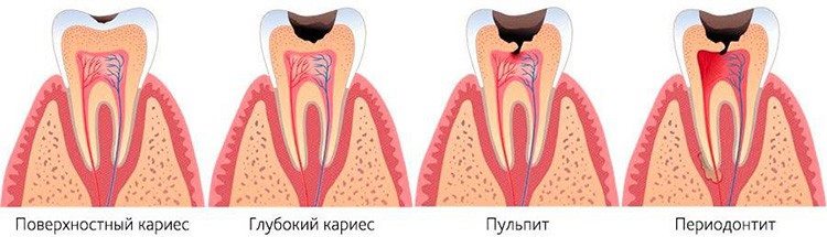 от кариеса до пульпита