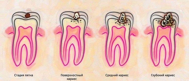 кариес зубов фото стадии