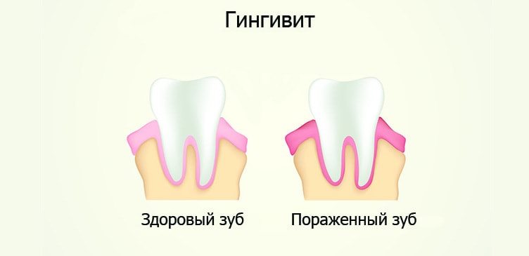 поражение десен