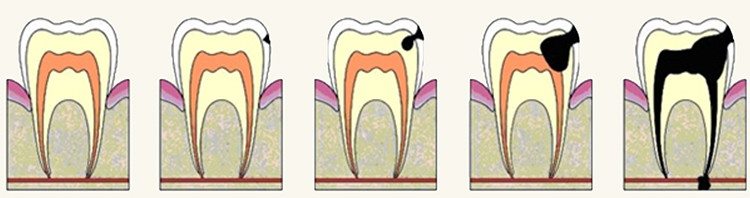 развитие болезни - кариес - пульпит - периодонтит