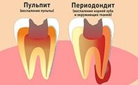 развитие пульпита