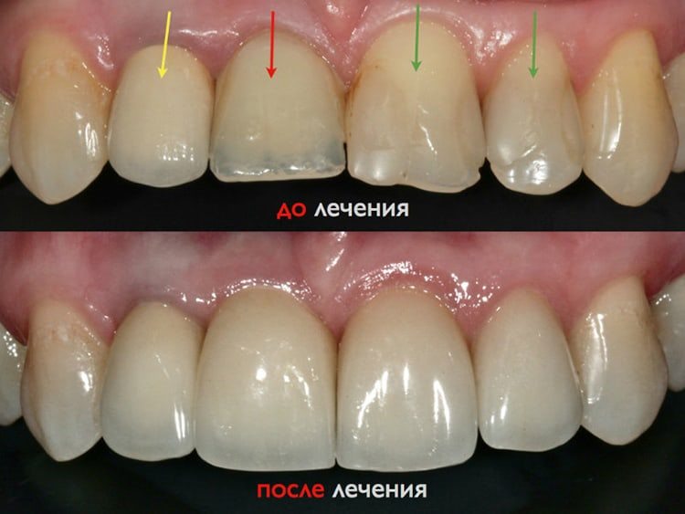 лечение эмали