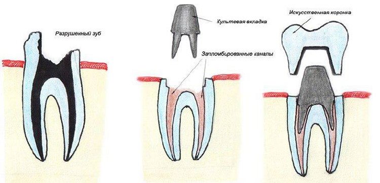 как установить коронки