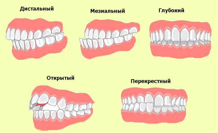 нарушения прикуса