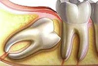 зуб мудрости мешает и болит