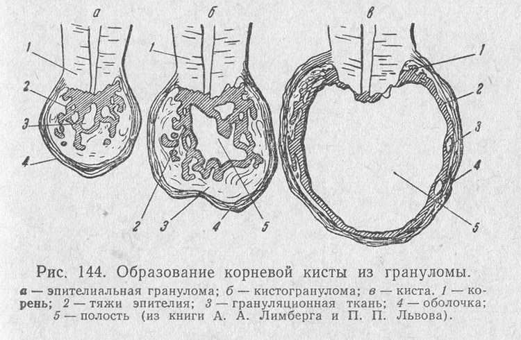 процесс образования кисты