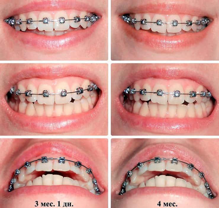 ношение металлических брекетов