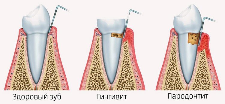 шинирование и болезни зубов