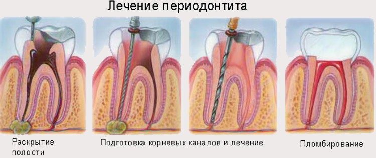 лечение воспаления тканей зубов и десен