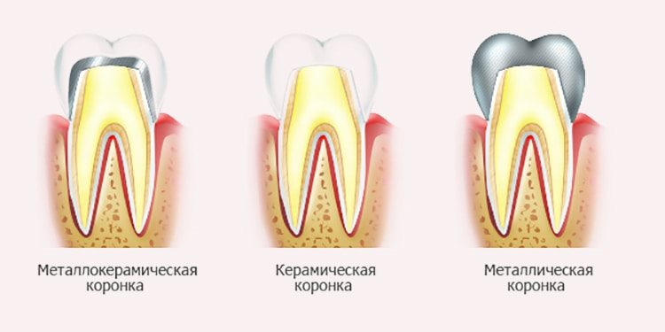 вид коронок