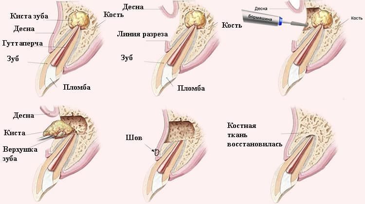 методика удаления кисты зуба