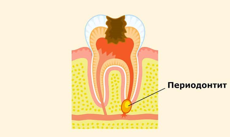 суть периодонтита