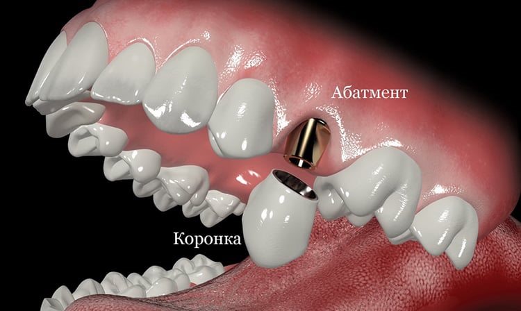 коронка на имплант - установка