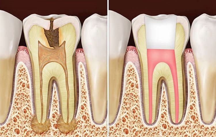 пломбирование каналов зуба