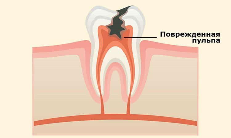 больная пульпа