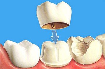 временная коронка на зуб