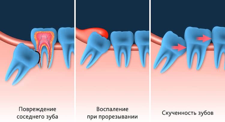 неправильно растущие зубы мудрости