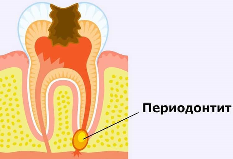 нагноение пульпы