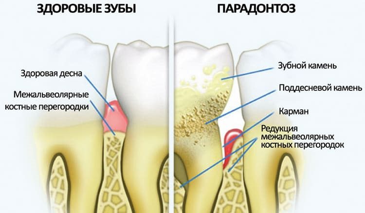 зубы больные парадонтитозом