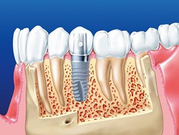 имплант в костной ткани