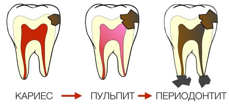 кариес - пульпит - периодонтит