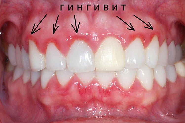 гингивит - что делать?