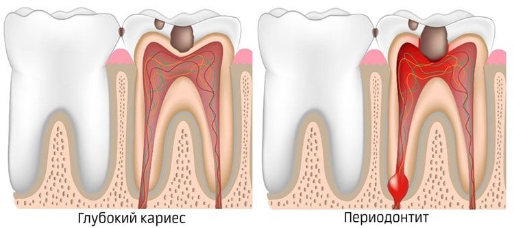 суть периодонтита