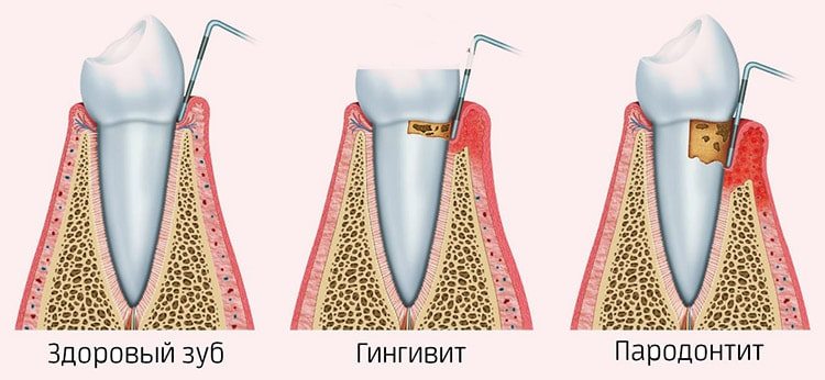 пародонт и его болезни