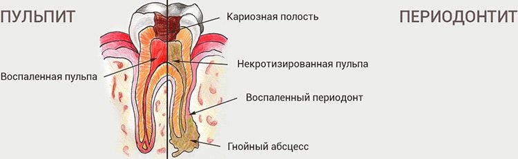 воспаление тканей зуба