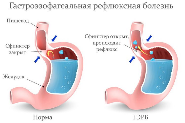 болезнь рефлюкс