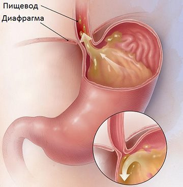 гэрб - болезнь желудка
