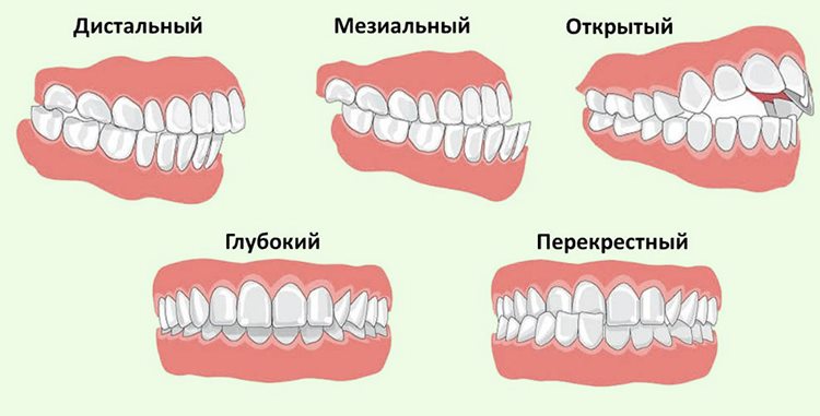 аномальный прикус