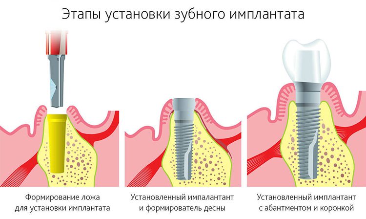 имплантация зубов