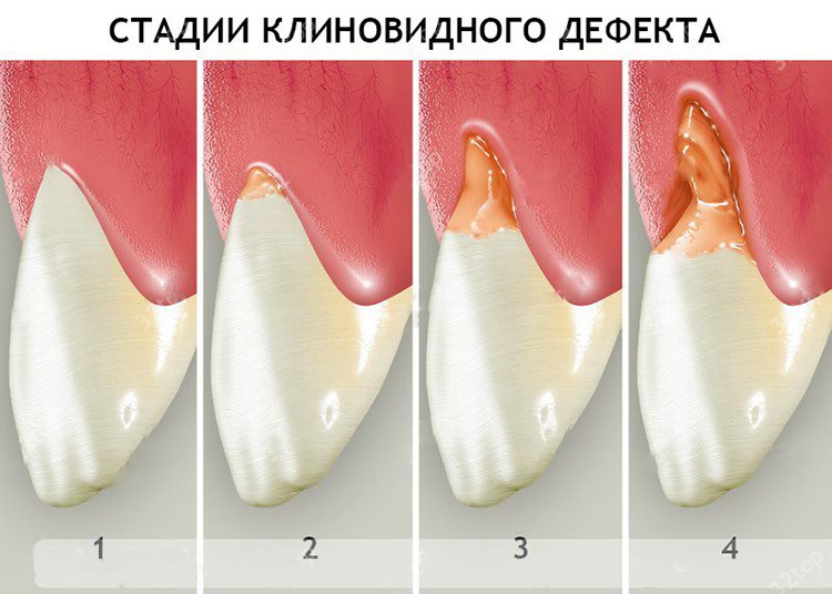 развитие дефекта клиновидного - до и после