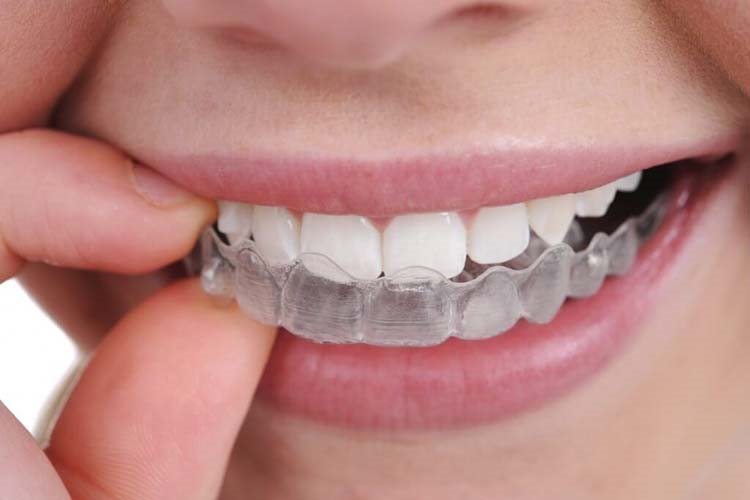 капа Invisalign