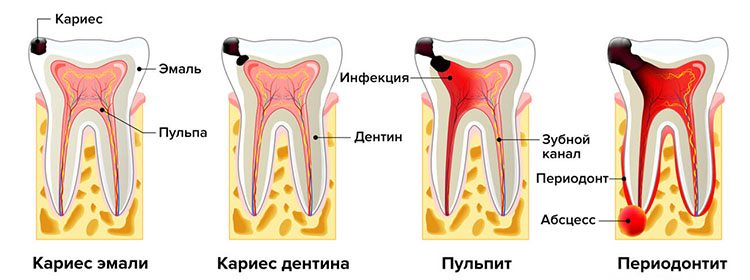 развитие кариеса