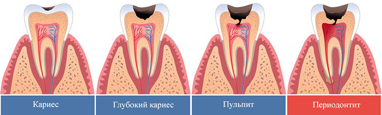 периодонтит и кариес