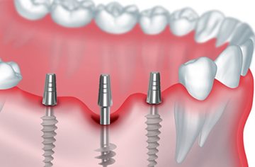 три имплантата