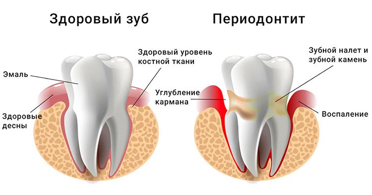 периодонтит зуба