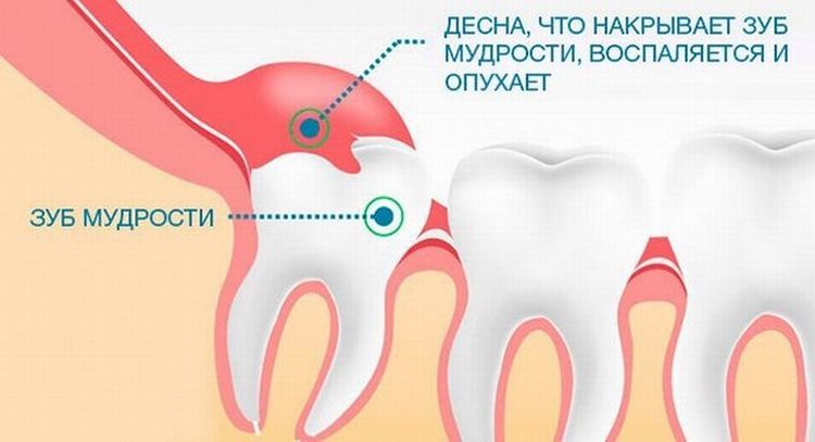 боль при неправильном прорезывании