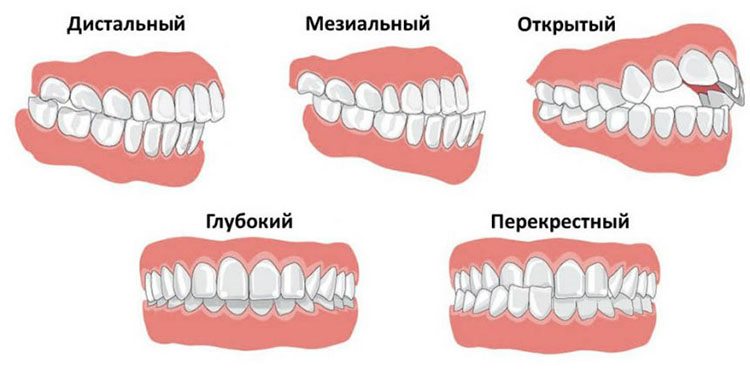 неправильный прикус