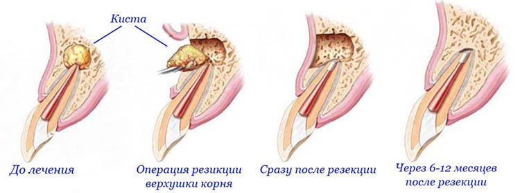 лечение кисты зуба