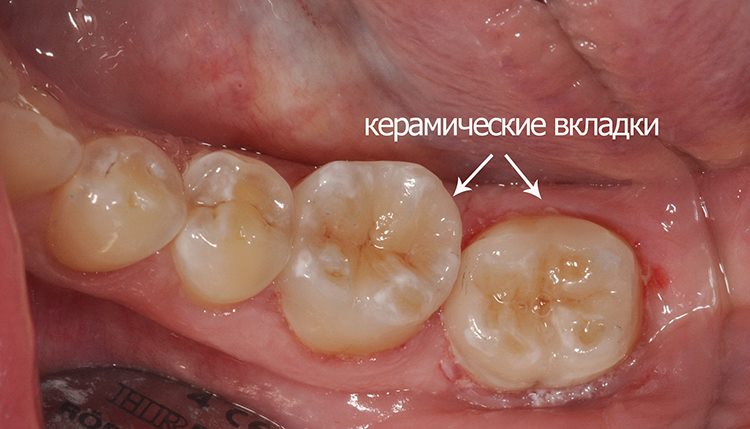 вкладки из керамики