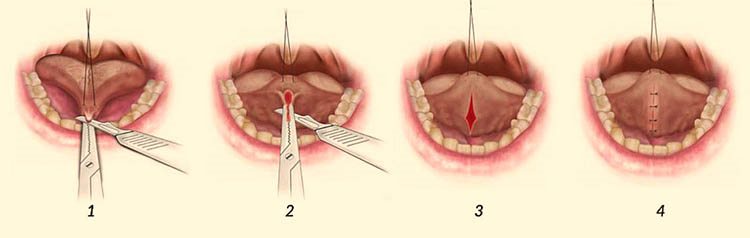 пластика уздечки языка