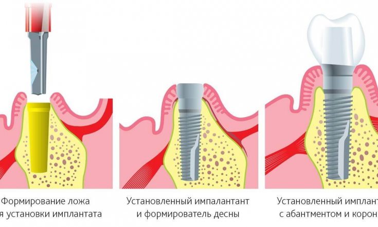 имплантация зубов