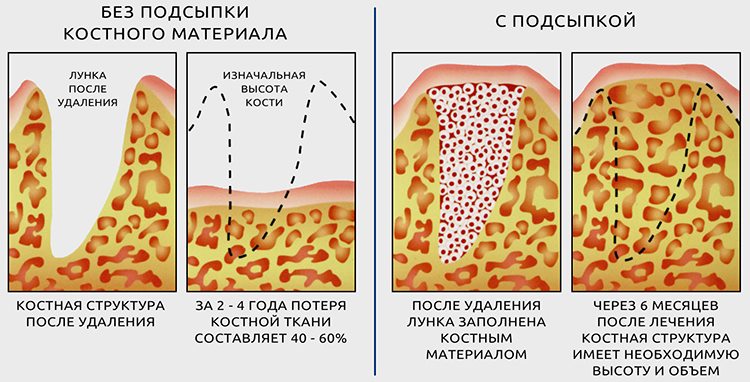 остеопластика